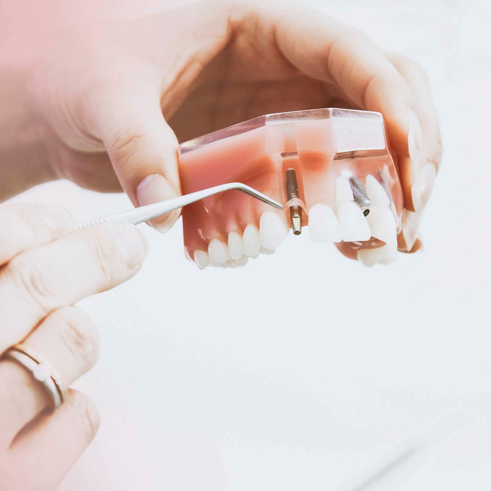 Implantes Dentários