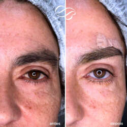 Blefaroplastia