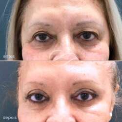 tratamento que rejuvenesce as pálpebras superiores e inferiores.