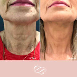 Bioestimuladores de colagénio