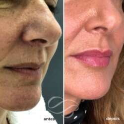 Harmonização Facial