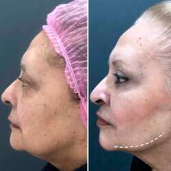 Lipoaspiração de papada