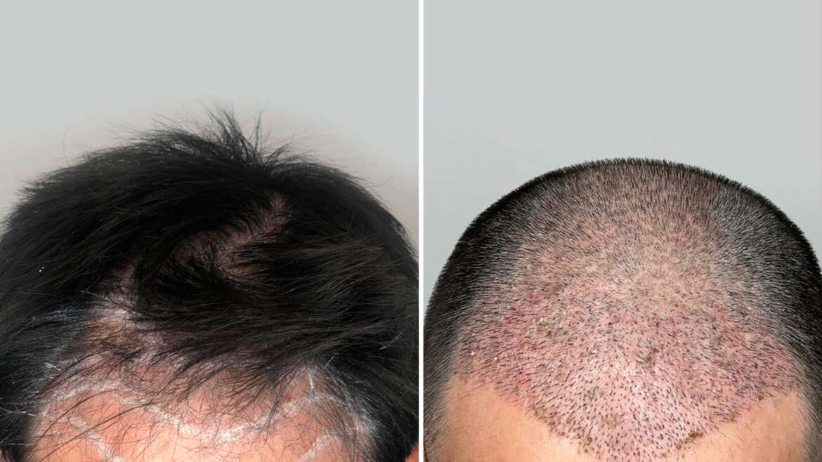 Transplante Capilar